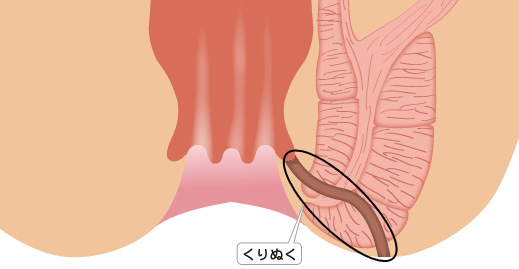 括約筋温存術式（coring out法）