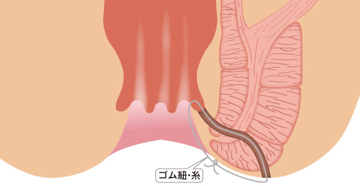 シートン法（seton法）