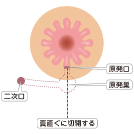 Hanley変法