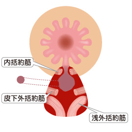 Hanley変法