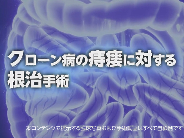 クローン病の痔瘻に対する根治手術～