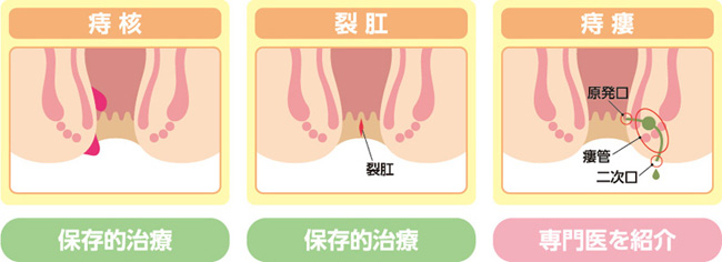 図1. 3大肛門疾患