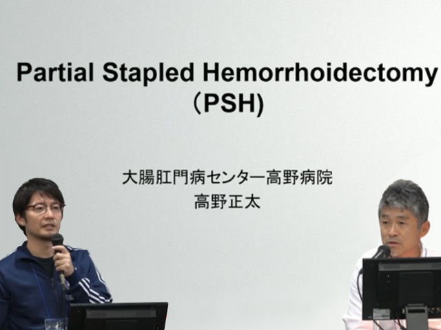 痔核に対するPartial Stapled Hemorrhoidectomy