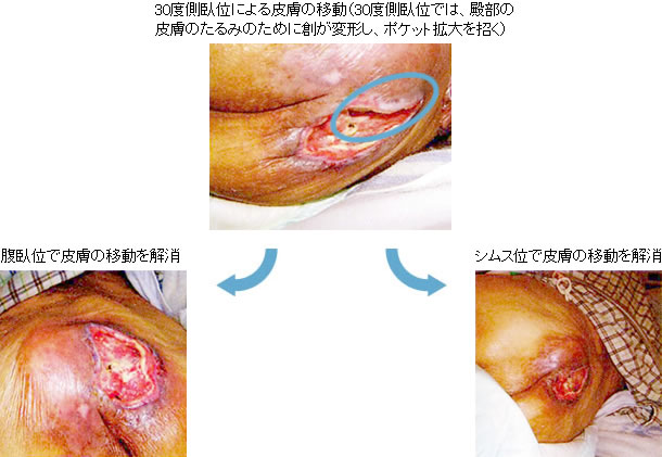 図：体位の工夫