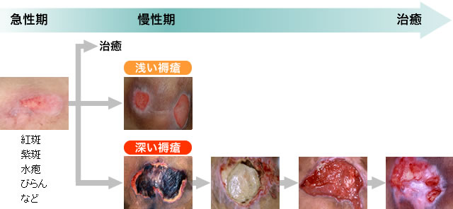図：褥瘡の進展様式