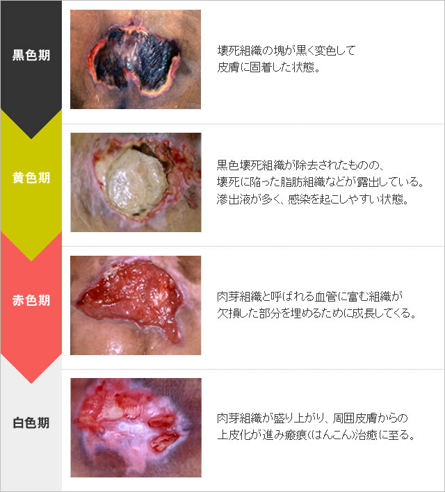 図：創面の色調による褥瘡の病期分類