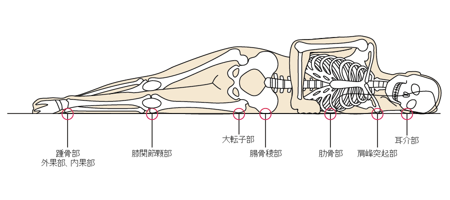 褥瘡のメカニズム 褥瘡辞典 For Medical Professional 医療関係者向け情報 マルホ株式会社