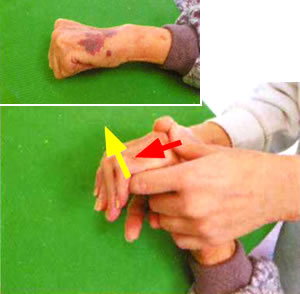 拘縮手指の伸ばし方(1)