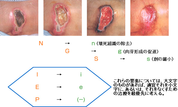 順調な創傷治癒はN、G、Sの順番に流れるが、I、E、Pに対しては、臨機応変に対処する。