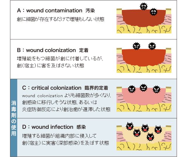 A：wound contamination 汚染
B：wound colonization 定着
C：critical colonization臨界的定着
D：wound infection 感染