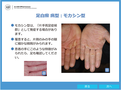 成人の皮膚真菌感染症I:皮膚糸状菌