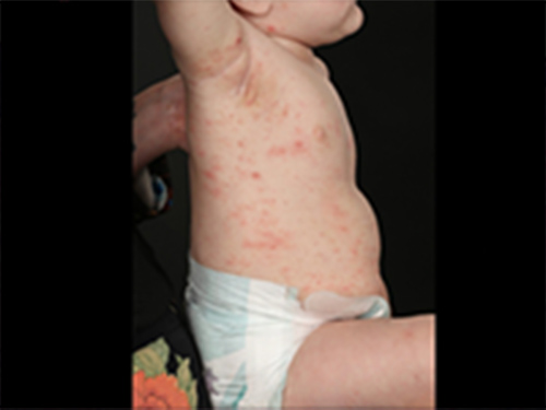 乳児に生じた広範囲のそう痒を伴う皮疹