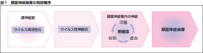 図1 顔面神経麻痺の発症機序