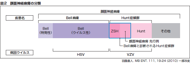 図2 顔面神経麻痺の分類