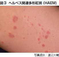 図3 ヘルペス関連多形紅斑（HAEM)