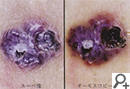 血管腫のルーペ像とダーモスコピー像