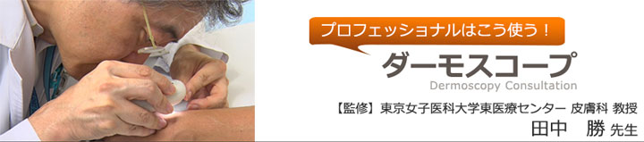 プロフェッショナルはこう使う！ダーモスコープ