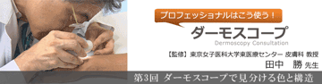 第3回 ダーモスコープで見分ける色と構造