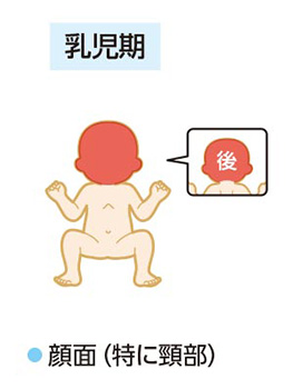 アトピー：好発部位の推移（乳児期）