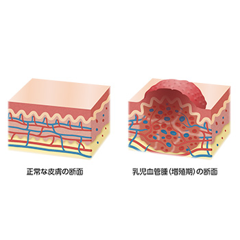 正常皮膚と乳児血管腫の皮膚断面