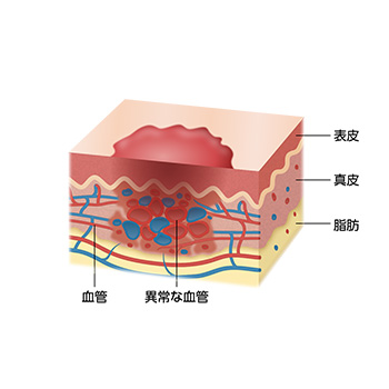 乳児血管腫詳しい皮膚断面