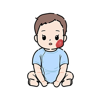 乳児血管腫の赤ちゃん