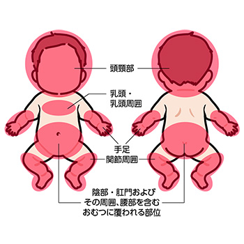 乳児血管腫好発部位