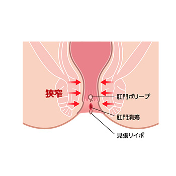 痔の種類（裂肛）