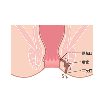 痔の種類（痔ろう）