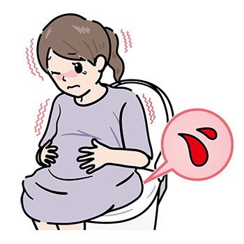 痔の妊婦
