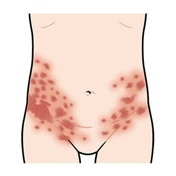 多形慢性痒疹お腹のイラスト