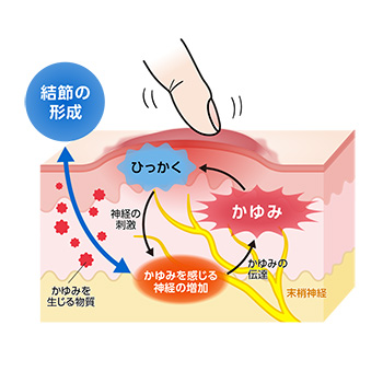 結節性痒疹皮膚の断面