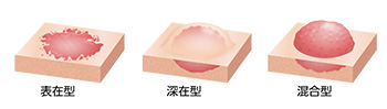 血管腫のタイプ（表在型、深在型、混合型）