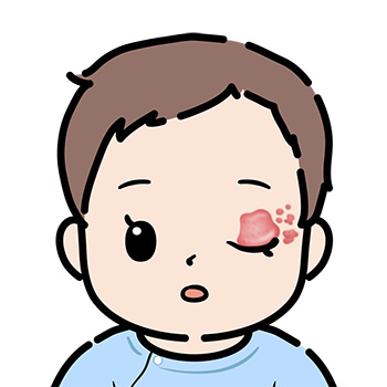 乳児血管腫-目の病変