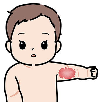 乳児血管腫-大きくただれた病変