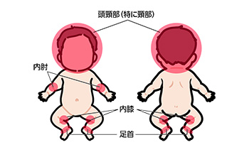 アトピー好発部位