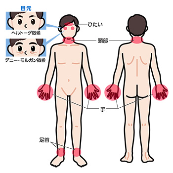 アトピー好発部位