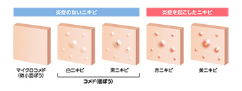ざ瘡ーニキビの種類