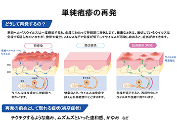 ヘルペスウイルス、帯状疱疹、単純疱疹のイラスト・スライド