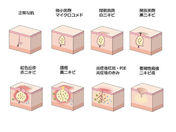 ざ瘡イラストのスライド