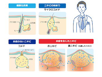 患者さんイラストを利用したスライドサンプル