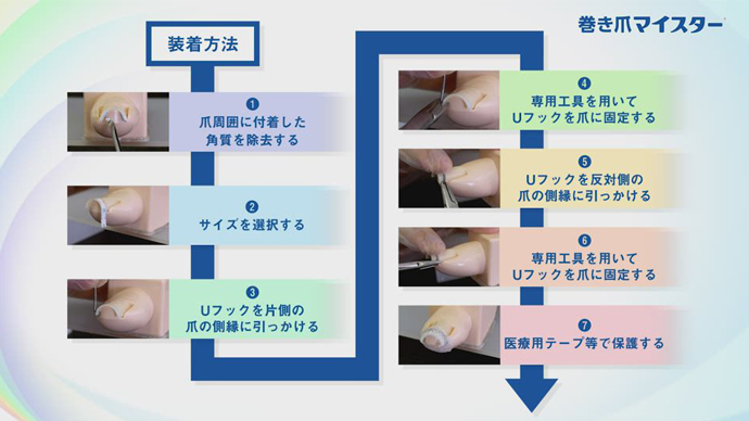 巻き爪マイスター装着動画