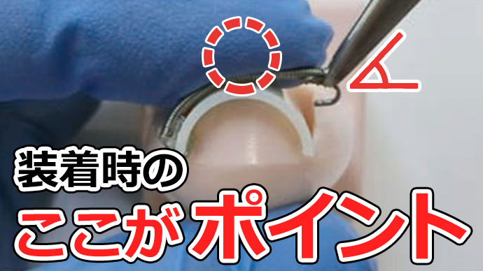 巻き爪マイスター装着経験者アンケート①～装着手技の実態～