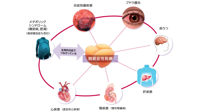 全身疾患としての乾癬（Psoriatic Disease）