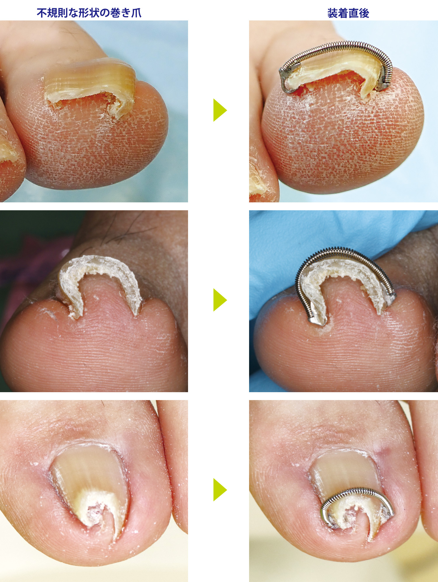 巻き爪マイスターの装着例-不規則