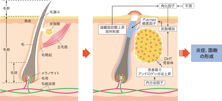 ざ瘡の発症メカニズム（左：正常、右：発症時）