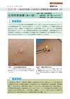 伝染性軟属腫（水いぼ）