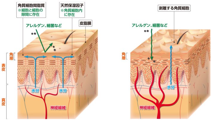 正常な皮膚とアトピー性皮膚炎患者の皮膚