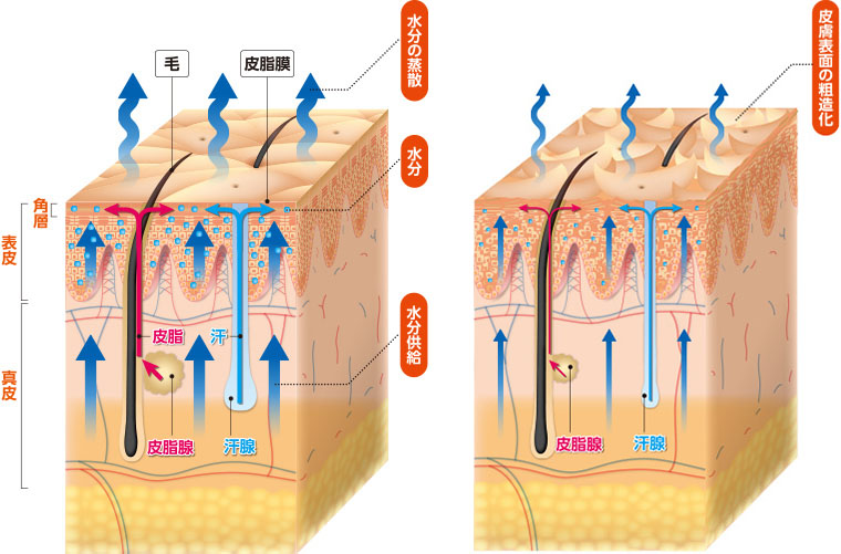 乾燥が起きる機序：正常な皮膚と透析患者の皮膚