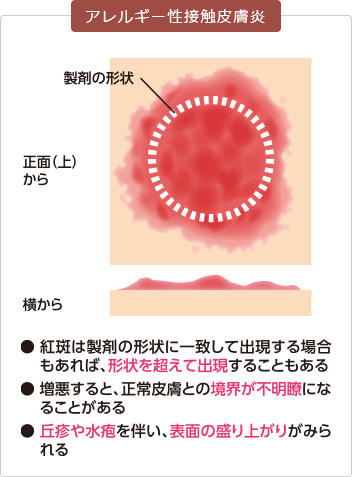 アレルギー性接触皮膚炎